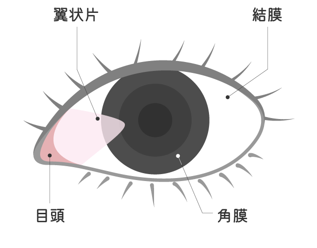 翼状片（よくじょうへん）とは？